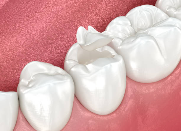 Best Dental Inlays and Onlays  in Punta Gorda, FL